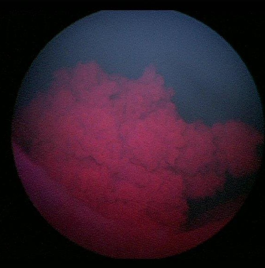 Blasentumor unter Blaulicht in der fluoreszenzgestützten Blasenspiegelung