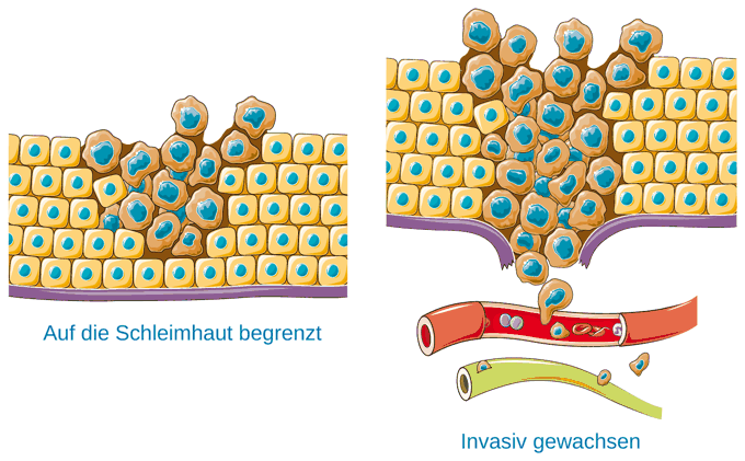 In situ und invasives Wachstum