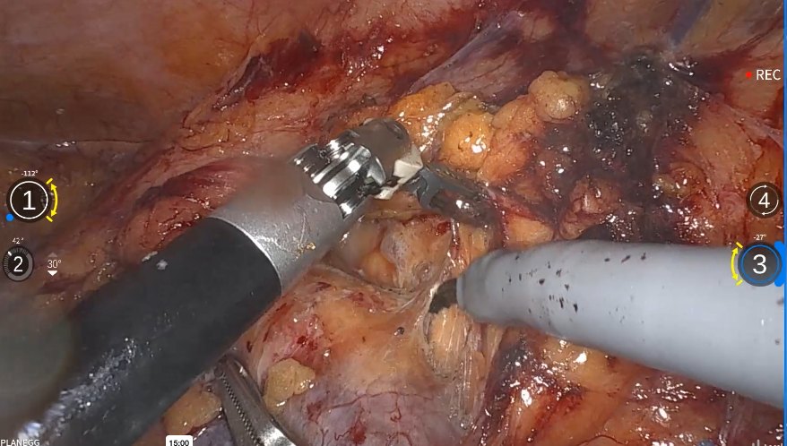 Blick der Kamera in den Operationssitus während einer roboterassistierten Prostataentfernung