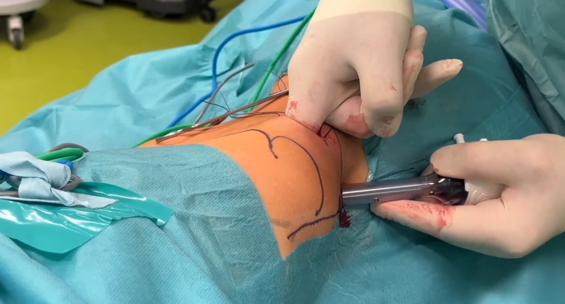 Einbringen eines Trokars durch die Bauchdecke bei einer roboterassistierten Operation